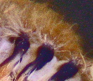 Infected Verrucae